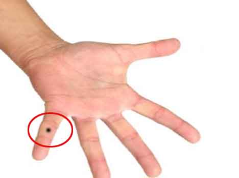 mole on right hand finger